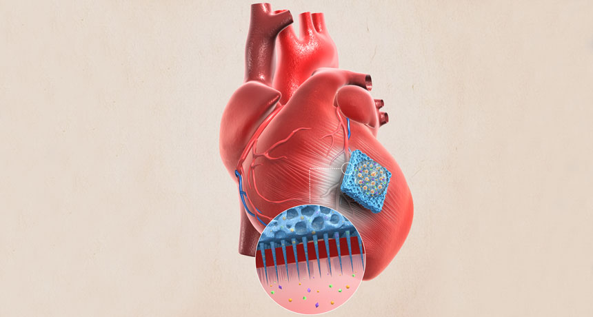 Edwards' SAPIEN 3 Ultra Transcatheter Heart Valve gets FDA nod