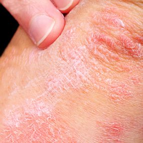 A patient afflicted with Psoriasis (Image Courtesy Healthline.com)